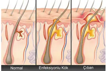 Çıban Kremi Kullanımı ve Faydaları Nelerdir?